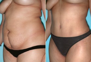 abdominoplastia