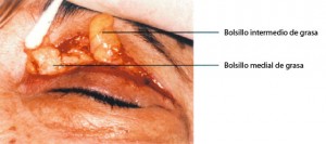 blefaroplastia07