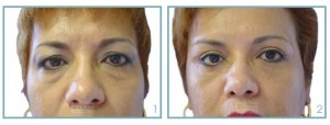 blefaroplastia2