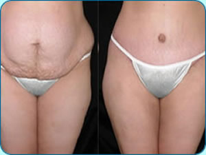 cicatriz-abdominoplastia-2